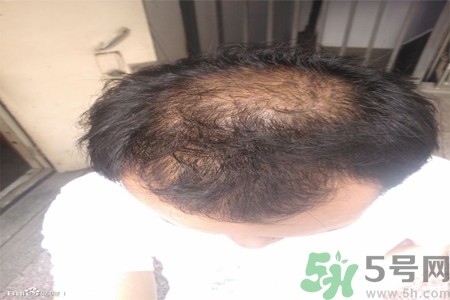 脫發的措施有什么？脫發的注意飲食有哪些？