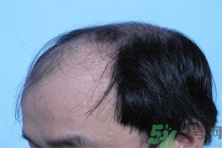 脫發的措施有什么？脫發的注意飲食有哪些？