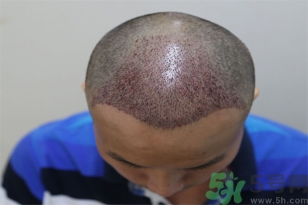 脫發的原因是什么？脫發會引發什么疾病？