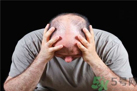 脫發的治療方法是什么？脫發的藥物治療有哪些？