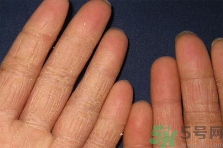 手足癬的治療方法？治療手足癬可以用什么藥？