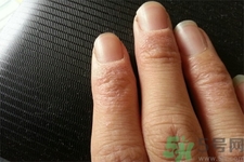手足癬的治療方法？治療手足癬可以用什么藥？