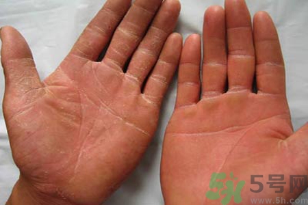 手足癬的治療方法？治療手足癬可以用什么藥？