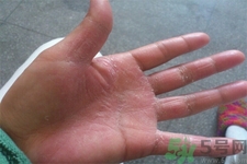 手足癬的易發(fā)人群有哪些？如何預防手足癬？