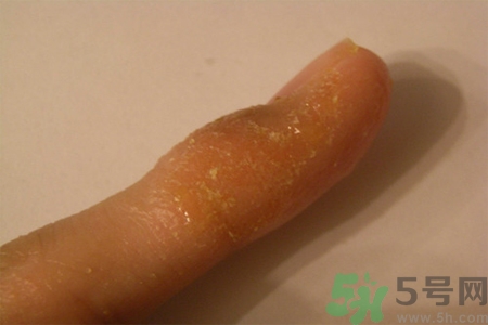 手足癬的易發(fā)人群有哪些？如何預防手足癬？