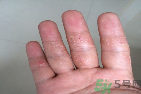 手足癬的易發(fā)人群有哪些？如何預防手足癬？