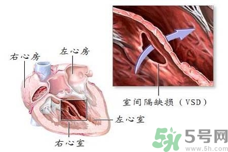 心臟病是怎么形成的？易發人群有哪些？