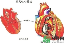心臟病的癥狀是什么？心臟病的種類有哪些？