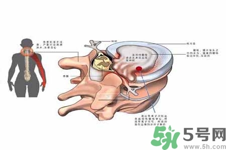 為什么年輕人容易得頸椎病？頸椎病嚴重的癥狀有哪些？