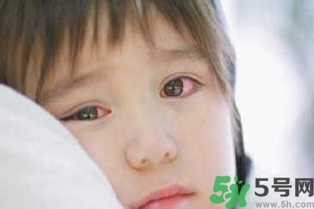 寶寶為什么會感染紅眼病？寶寶患紅眼病如何治療？