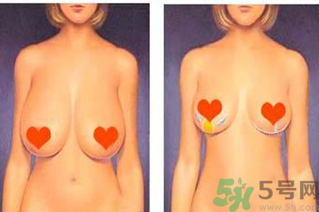 ?女性乳房下垂的原因是什么？女性乳房下垂的分類有哪些？
