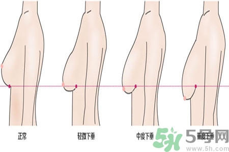 ?女性乳房下垂的原因是什么？女性乳房下垂的分類有哪些？
