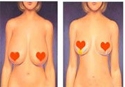 ?女性乳房下垂的原因是什么？女性乳房下垂的分類有哪些？