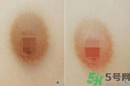 乳頭發黑怎么辦？怎么樣可以使乳頭變白？