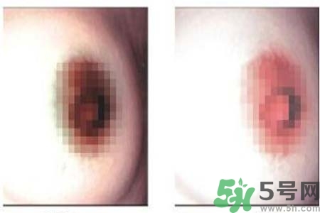 乳頭發黑怎么辦？怎么樣可以使乳頭變白？