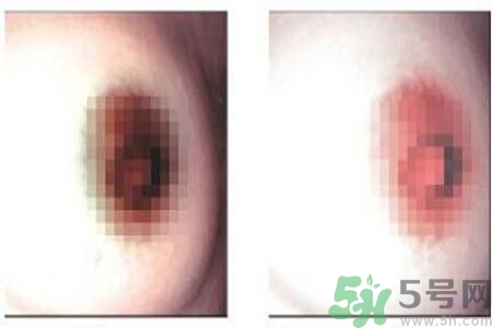 乳頭發(fā)黑是怎么回事？乳頭發(fā)黑是什么原因？