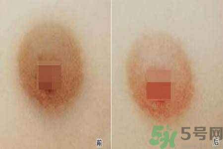 乳頭發(fā)黑是怎么回事？乳頭發(fā)黑是什么原因？