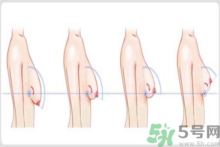 胸部松弛的原因是什么？胸部松弛該怎么辦？