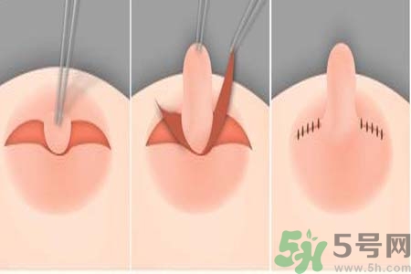 乳頭內陷怎么回事？乳頭內陷的原因是什么？