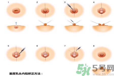 乳頭內陷怎么回事？乳頭內陷的原因是什么？