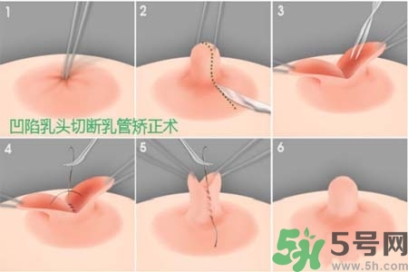 乳頭內陷怎么辦？乳頭內陷的癥狀有哪些？