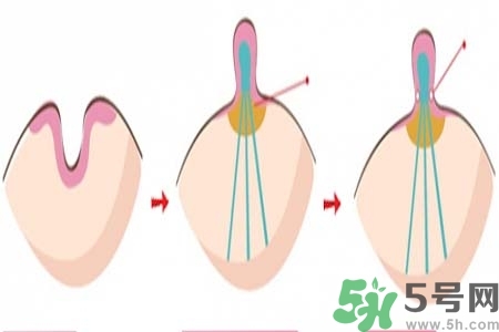 乳頭內陷怎么辦？乳頭內陷的癥狀有哪些？
