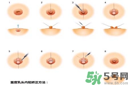 乳頭內陷怎么辦？乳頭內陷的癥狀有哪些？