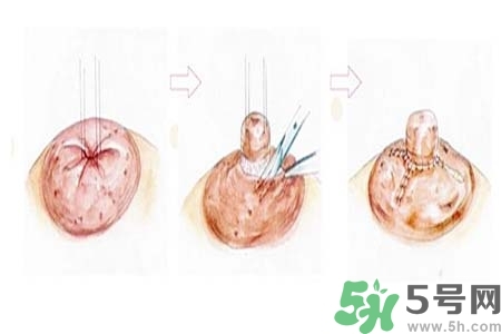 乳頭內陷怎么辦？乳頭內陷的癥狀有哪些？