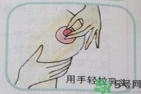 乳頭內陷怎么辦？乳頭內陷的癥狀有哪些？