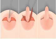 乳頭內(nèi)陷怎么辦？乳頭內(nèi)陷的癥狀有哪些？