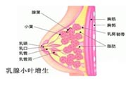乳腺增生治療方法是什么？乳腺增生的檢查方法有哪些？