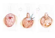 乳頭內(nèi)陷矯正需注意什么？乳頭內(nèi)陷如何預(yù)防？