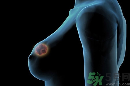 乳房有硬塊正常嗎？乳房有腫塊怎么回事？