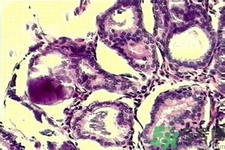 產生乳腺增生鈣化的病因是什么？乳腺增生怎樣治療？