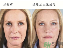 3D液態(tài)拉皮多少錢？3D液態(tài)拉皮后多久見效？