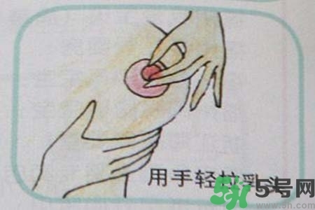 乳頭內(nèi)陷怎么矯正？乳頭內(nèi)陷矯正方法是什么？