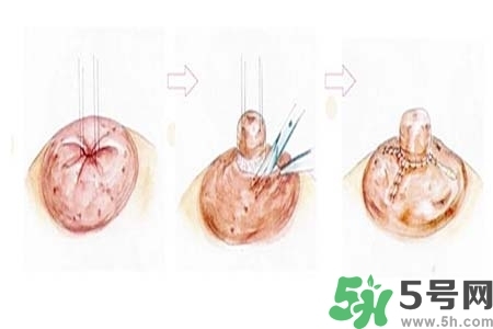 乳頭內(nèi)陷怎么矯正？乳頭內(nèi)陷矯正方法是什么？