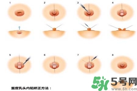 乳頭內(nèi)陷怎么矯正？乳頭內(nèi)陷矯正方法是什么？