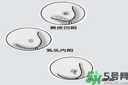 乳頭內(nèi)陷怎么矯正？乳頭內(nèi)陷矯正方法是什么？