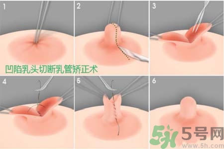 乳頭內(nèi)陷怎么矯正？乳頭內(nèi)陷矯正方法是什么？