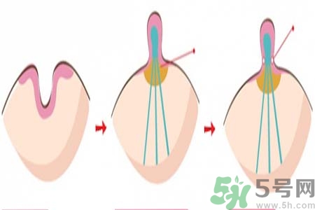乳頭內陷矯正需注意什么？乳頭內陷如何預防？