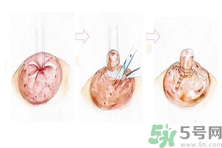 乳頭內陷矯正需注意什么？乳頭內陷如何預防？