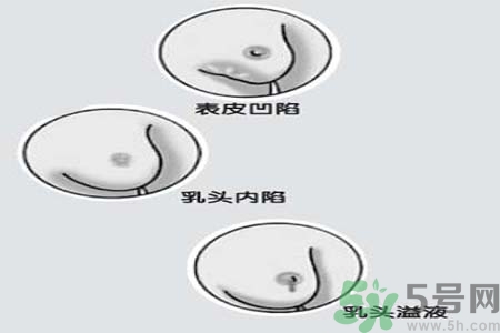 乳頭內陷矯正需注意什么？乳頭內陷如何預防？