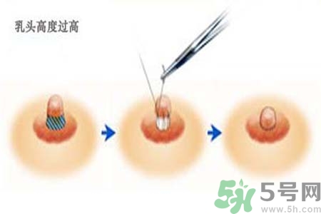 乳頭內陷能不能喂奶？乳頭凹陷怎樣哺乳？