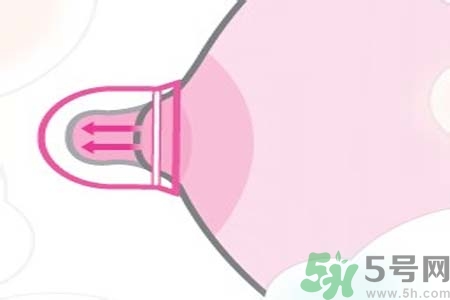 乳頭內陷可以拔罐嗎？乳頭內陷需要手術治療嗎？