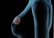 哺乳期乳房有硬塊疼痛怎么辦？如何預(yù)防哺乳期乳房有硬塊？