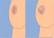 乳頭內(nèi)陷可以用吸奶器嗎？乳頭內(nèi)陷能不能用吸奶器？