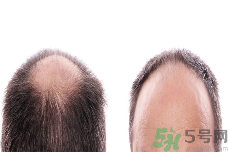 頭發(fā)稀少的原因是什么？如何預(yù)防禿頂?shù)陌l(fā)生？