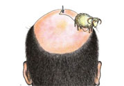 禿頂會遺傳嗎？治療禿頂的方法是什么？