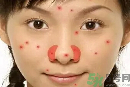 鼻翼長(zhǎng)痘痘怎么回事？鼻翼長(zhǎng)痘痘的原因是什么？
